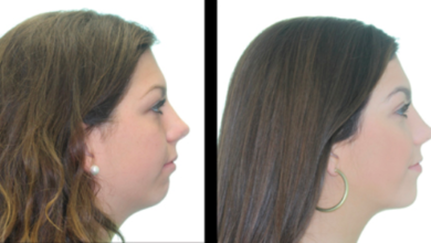 Jaw Reconstruction Surgery