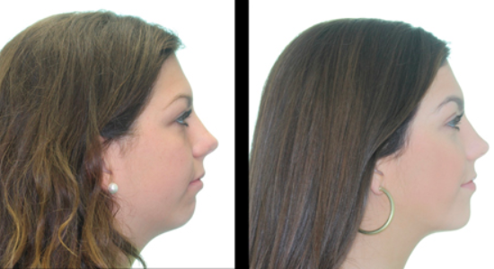 Jaw Reconstruction Surgery